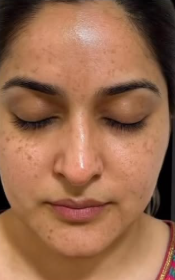 Before Skin